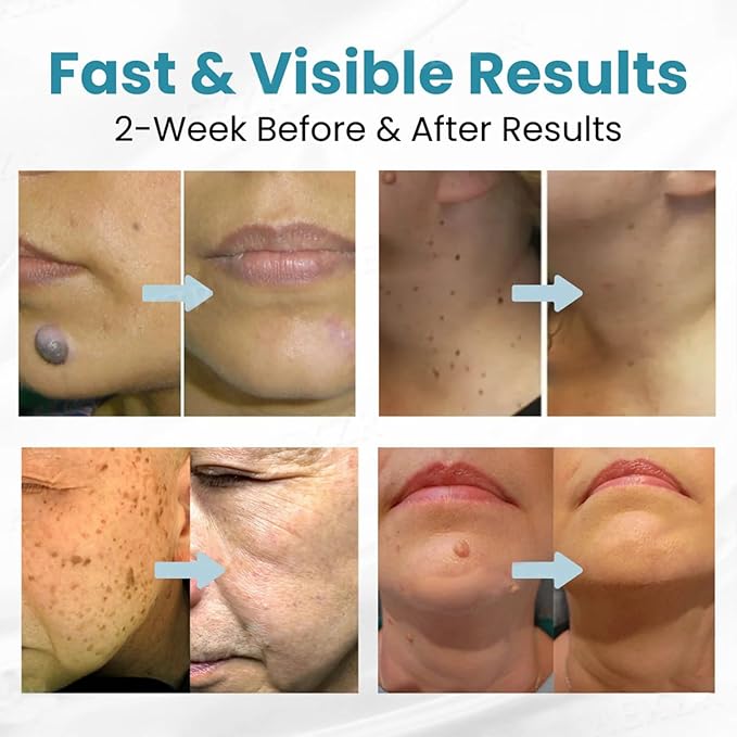 Mole Remover