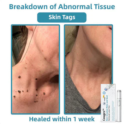 Mole Remover